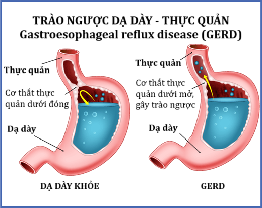 Trào ngược dạ dày thực quản