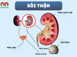 Sỏi tiết niệu (sỏi thận, sỏi niệu quản, sỏi bàng quang)