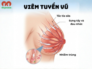 Viêm tuyến vú, tắc tia sữa