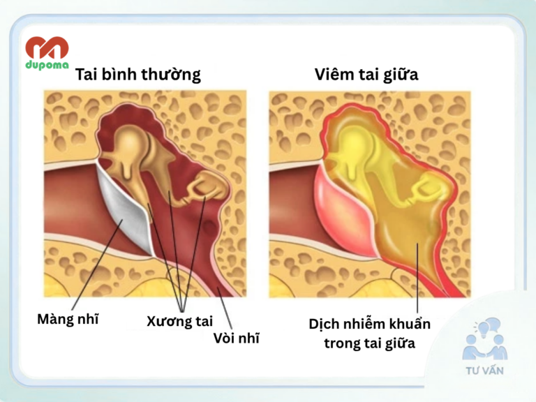 Viêm tai giữa