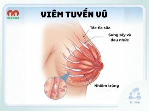 Viêm tuyến vú, tắc tia sữa