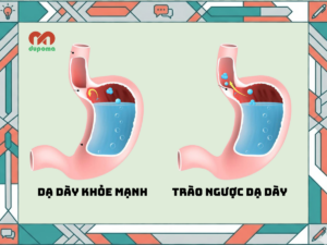 trào ngược dạ dày - thực quản