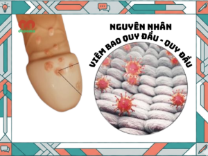 Nguyên nhân gây viêm bao quy đầu