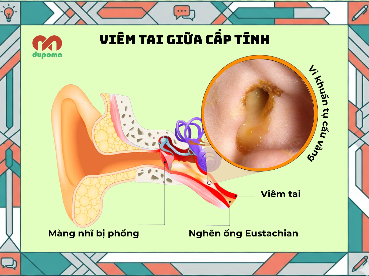 Triệu chứng và chẩn đoán viêm tai giữa cấp - DUPOMA