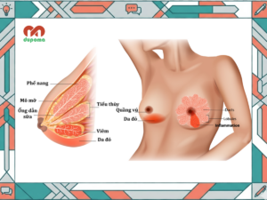 Viêm tắc tia sữa, viêm tuyến vú trong đông y