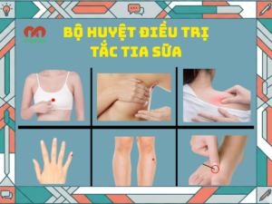 Bộ huyệt điều trị tắc tia sữa, viêm tuyến vú
