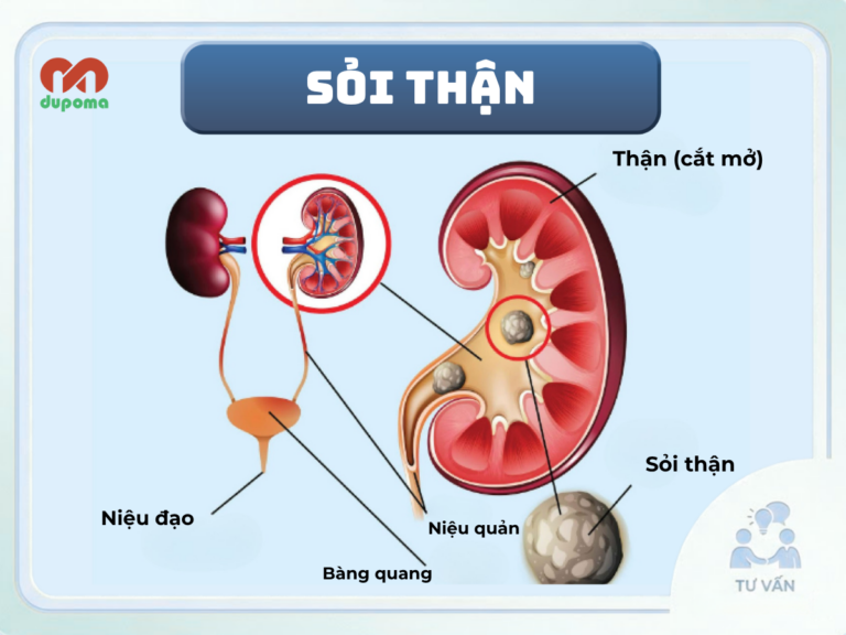 Sỏi tiết niệu (sỏi thận, sỏi niệu quản, sỏi bàng quang)
