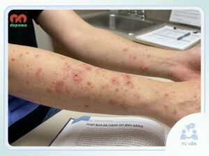 Phát ban đa dạng do ánh sáng